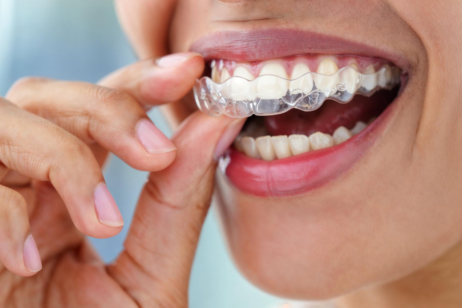 Braces & Clear Aligners
